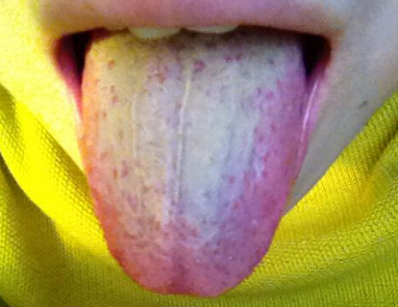 舌苔白又厚是怎么回事